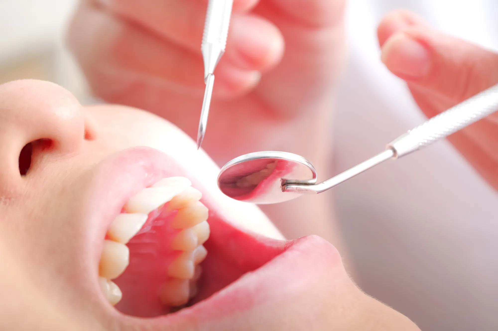 虫歯は自然に治る？放置していいケースと受診の目安｜桑園で歯科をお探しの方へ